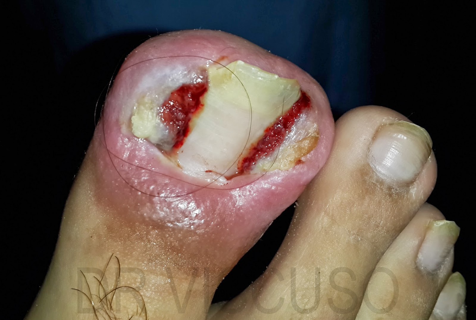 Como sanar el hongo sobre las uñas de los pies por la sosa